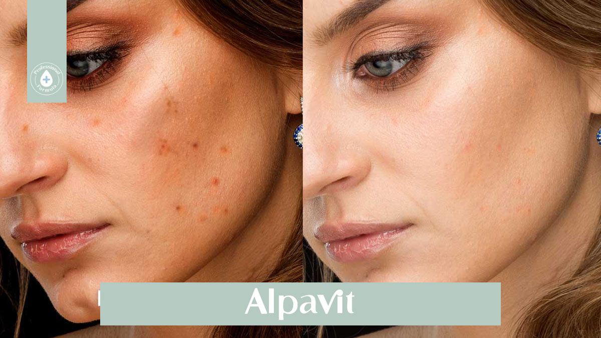 ملاسما و روش های درمان